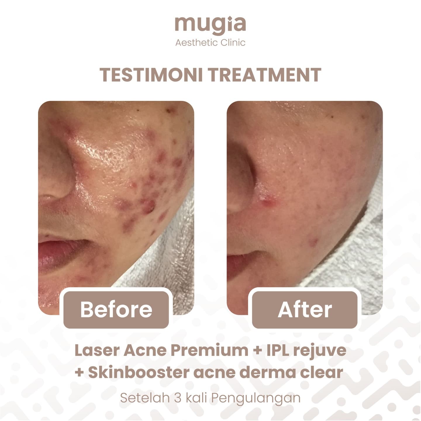 Acne Clear Treatment