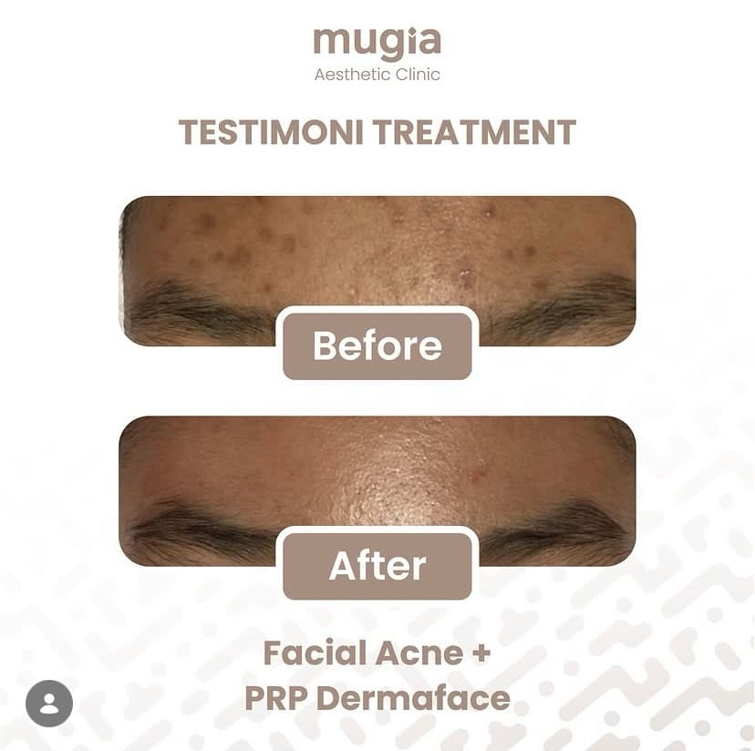 Facial Glow Treatment
