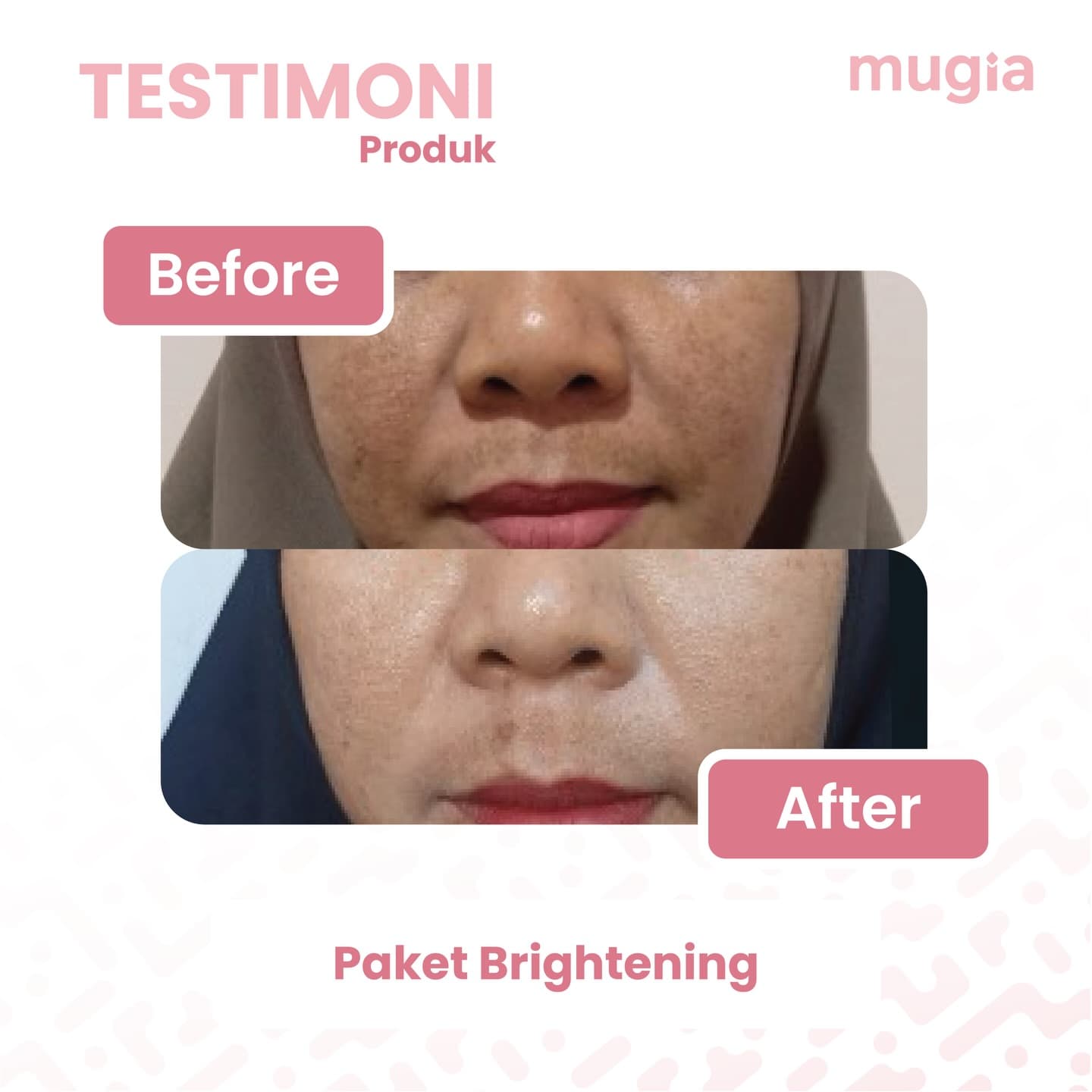 Derma Treatment