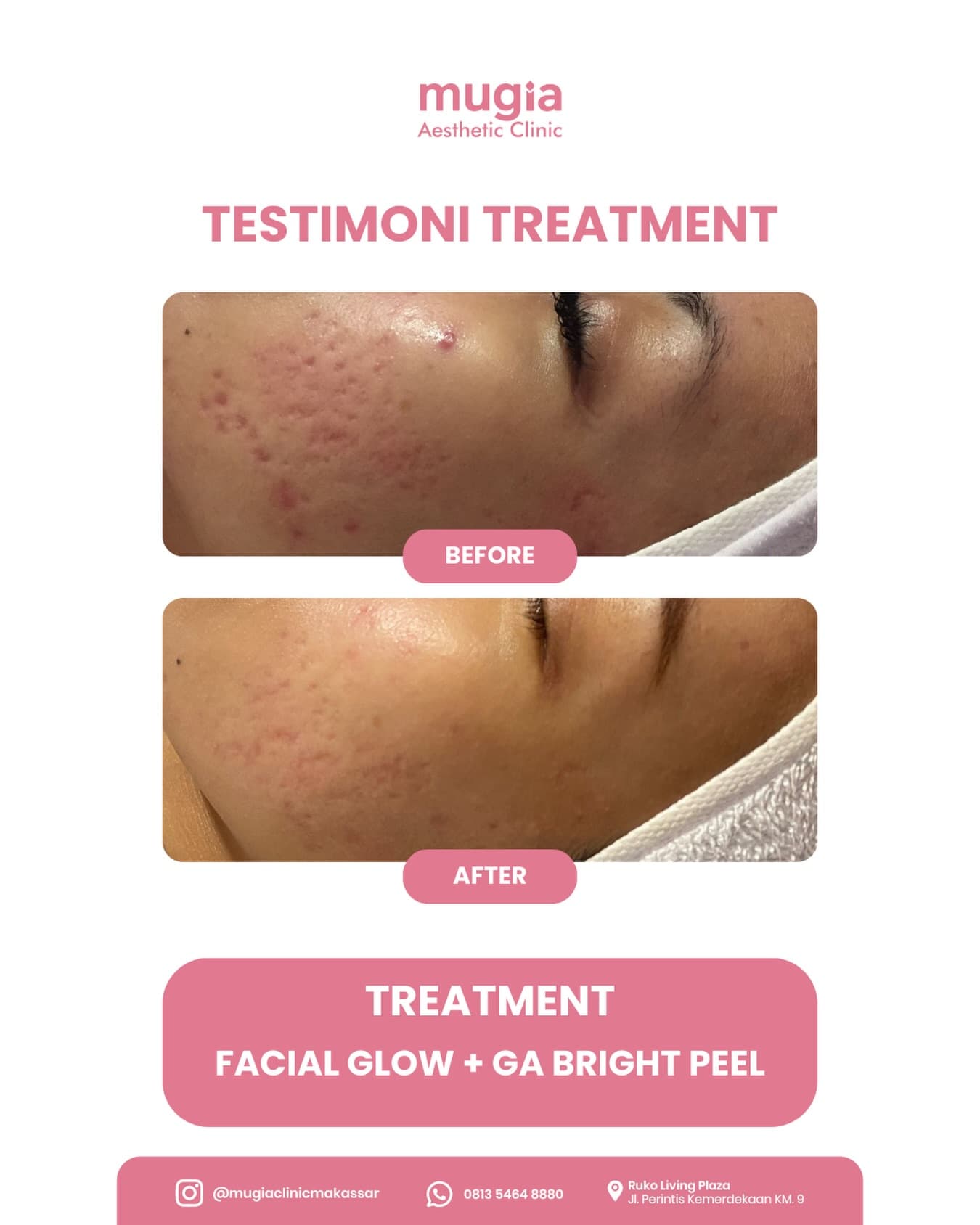 Laser Brightening